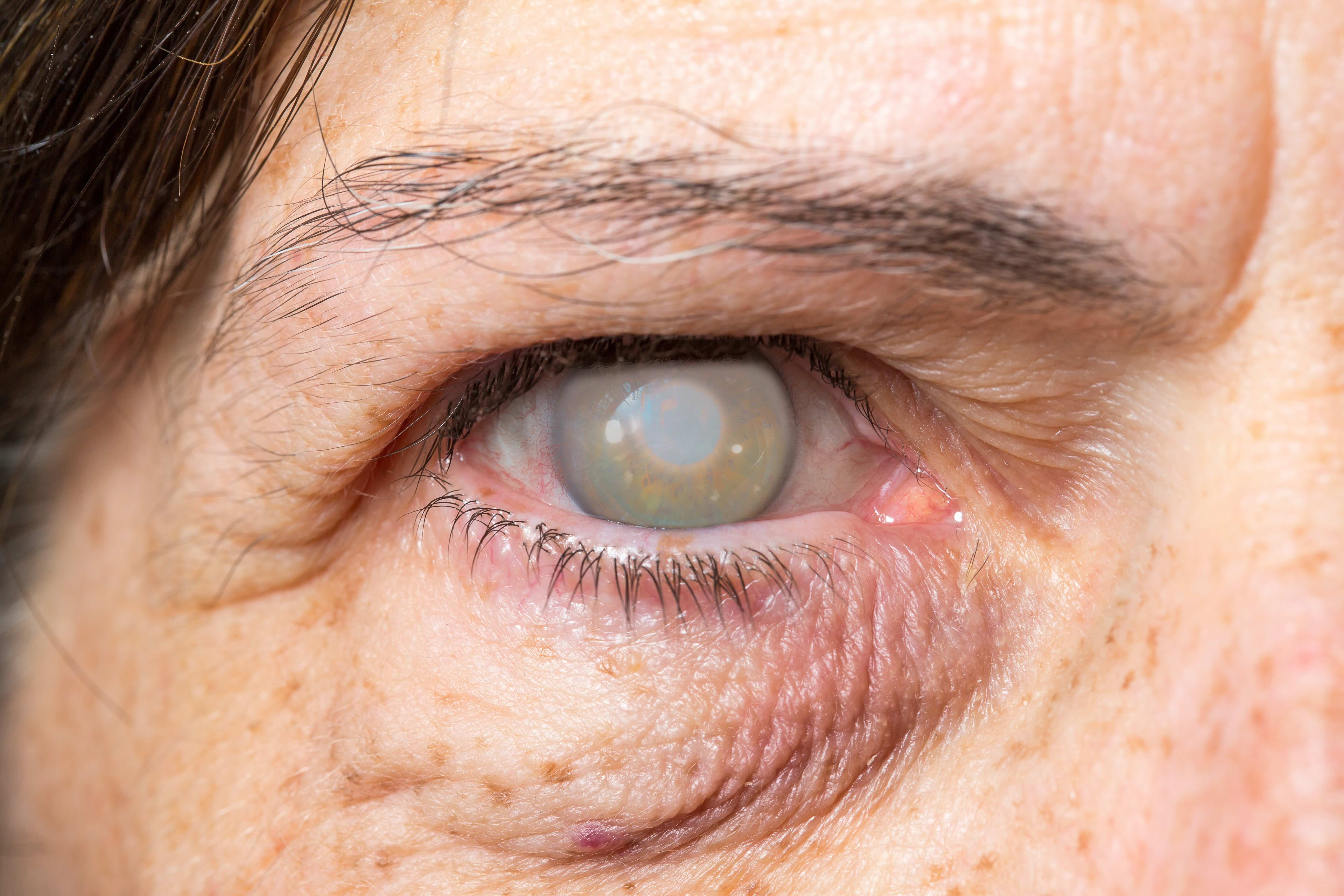 blindness-one-eye-mature-woman-corneal-opacity-cataract.jpeg