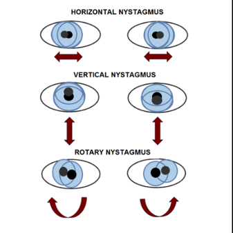 Nystagmus.png