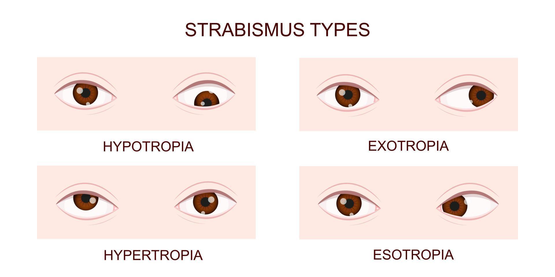 strabismus-types-hypotropia-hypertropia-exotropia-esotropia-human-eyes-with-different-squint-disorders-crossed-eyes-condition-vector.jpg