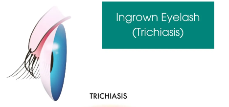Trichiasis.png
