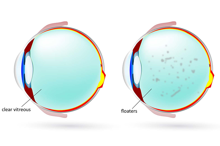 Apakah Floaters Berbahaya atau Tidak?  RS Mata SMEC